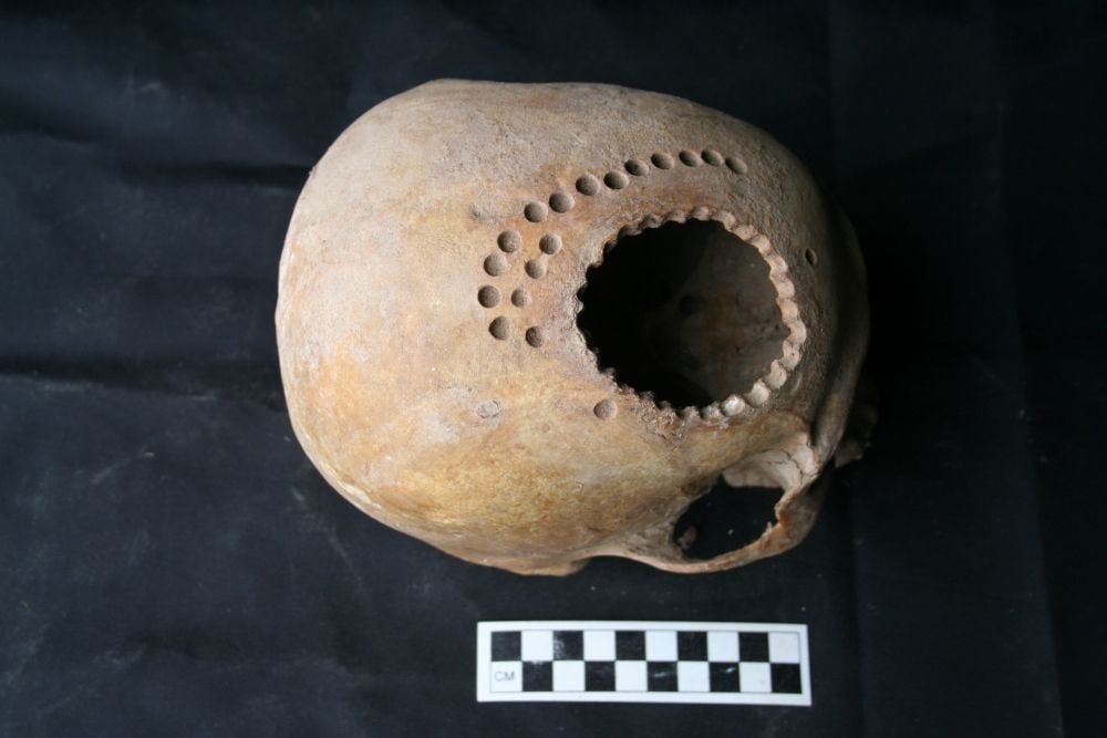 1,000 Years Ago, Patients Survived Brain Surgery, But They Had To Live With Huge Holes in Their Heads | Smithsonian