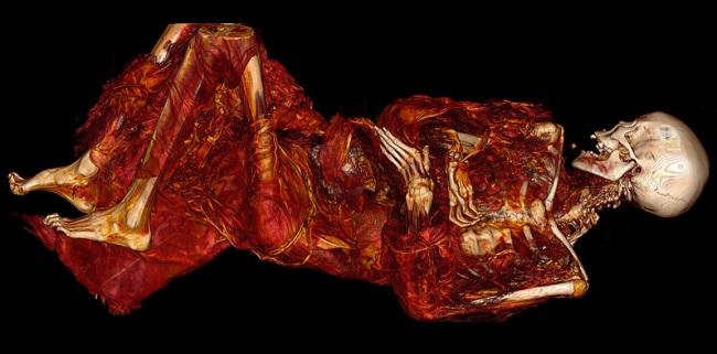 Atherosclerosis Seen in 500-Year-Old Inuit Mummies | tctmd.com