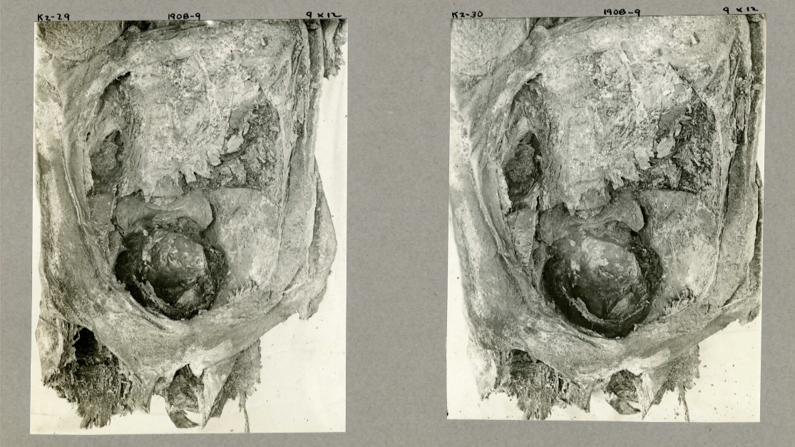 Ancient Egyptian teenager died while giving birth to twins, mummy reveals |  Live Science