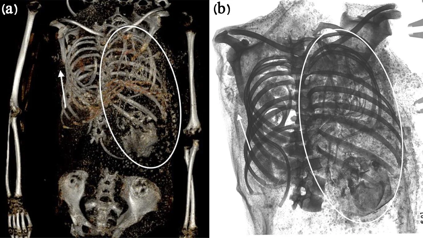 Shocking discovery of ancient Egyptian teen mom's tragic childbirth |  Archaeology News Online Magazine