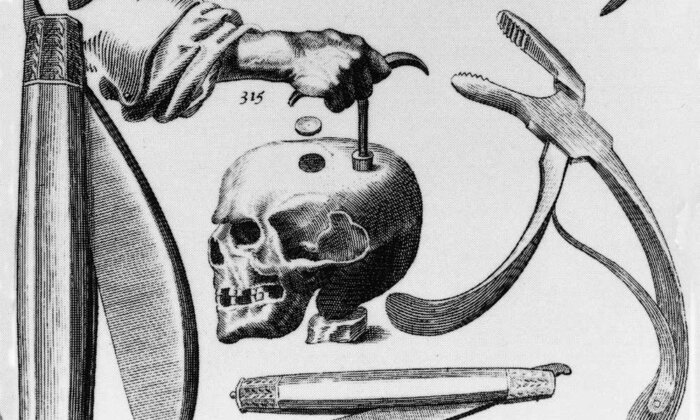 A Hole in the Head: A History of Trepanation | The MIT Press Reader