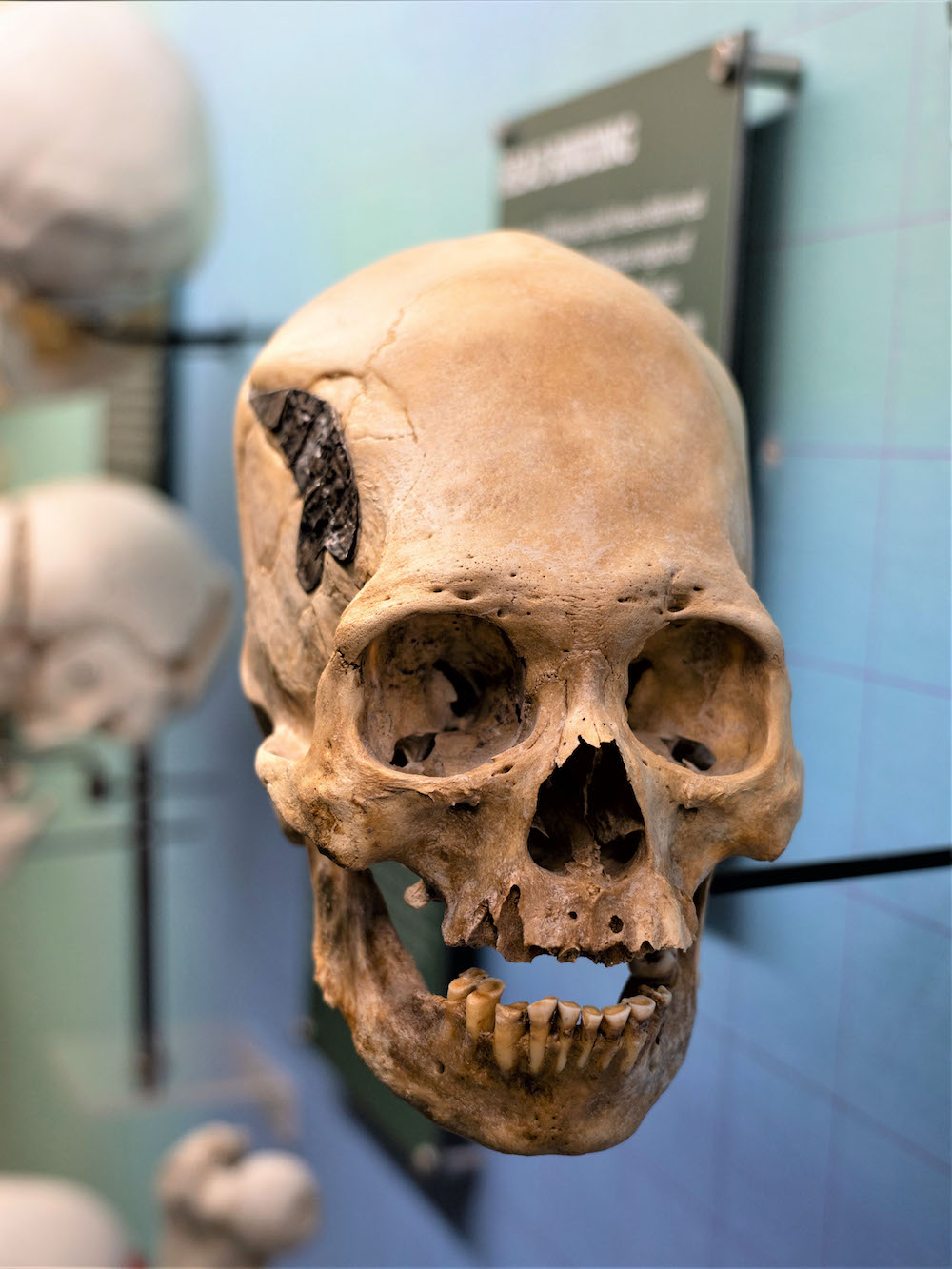 Ancient Peruvian skull with metal implant baffles scientists | SYFY WIRE