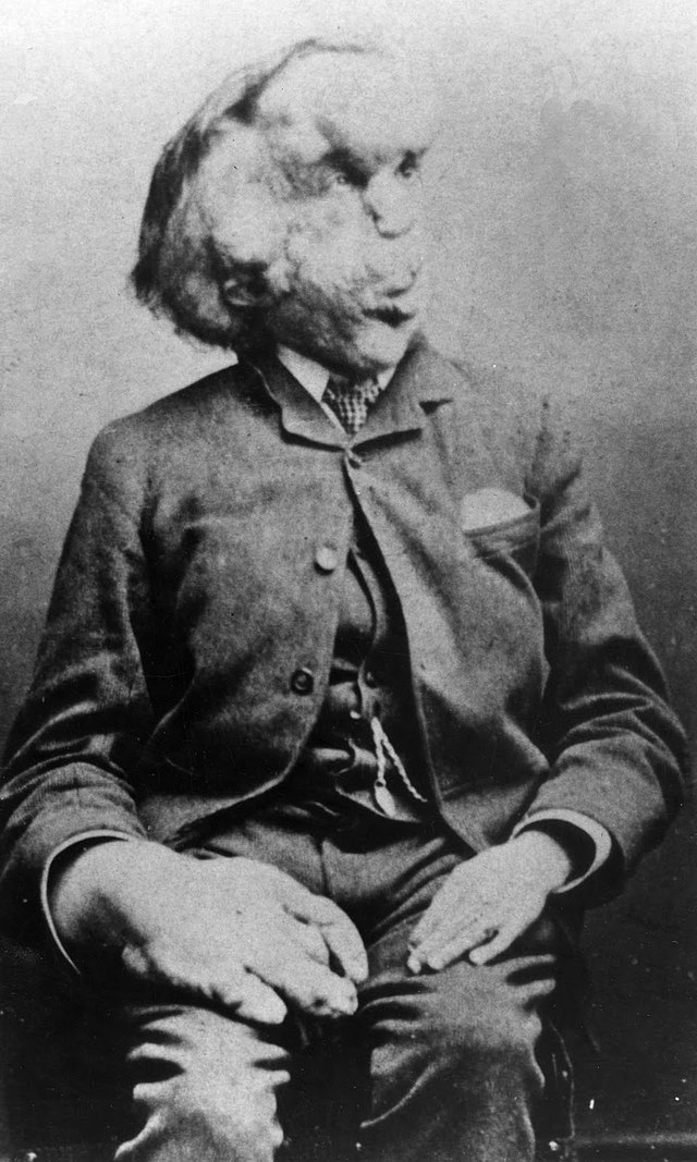 Joseph Merrick - Wikipedia