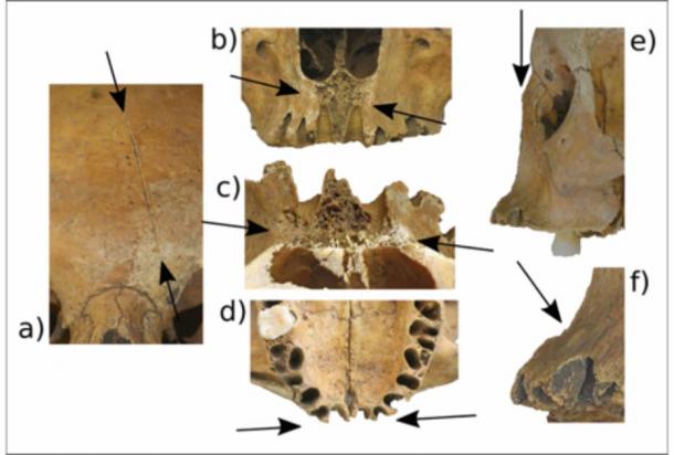 Close up of views of the facial trauma: a) the oblique frontal cut, b) from the front, c) from above, d) the anterior of the maxilla, e) the linear cut through the lateral margin of the nasal aperture, f) the sharp nick on the right side. The cuts and nicks are marked by arrows. (G. Cole / Antiquity Publications Ltd)