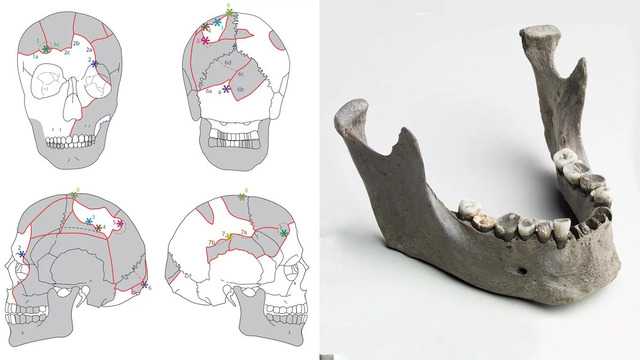 (Left) A detailed diagram of Vittrup Man’s cranium shows eight impact lesions with radiating fracture lines. (Right) His jawbone, with worn and corroded teeth, reveals evidence of diet and wear. 