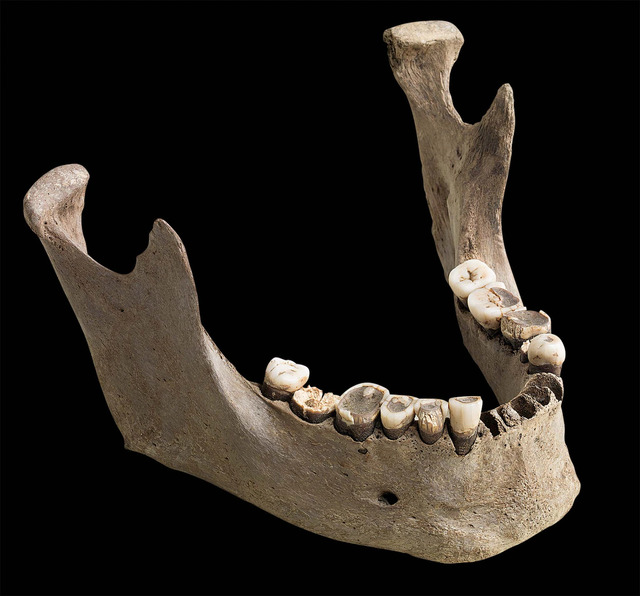 The condition of Vittrup Man’s teeth provided critical insight into his diet and geographic origins.