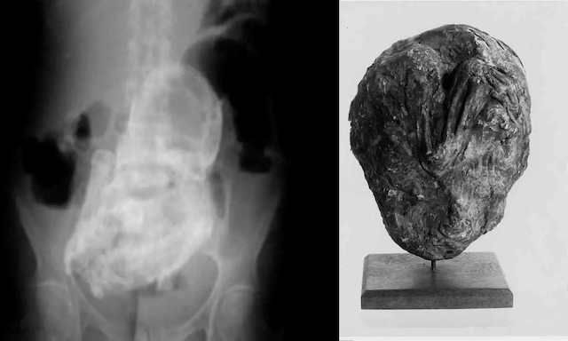 An X-ray image of the calcified fetus, known as a "stone baby," found inside Estela Meléndez after she had an accidental fall, revealing a medical mystery within