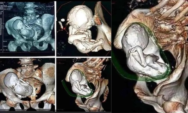 3D scans showcasing the intricate details of the 60-year-old mummified fetus inside the body of Estela Meléndez, preserved naturally by her body for decades