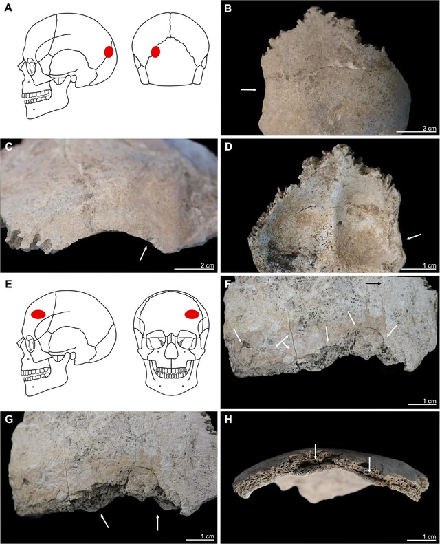 An assortment of perimortem cranial trauma cases, featuring detailed locations and osteological analysis of the lesions.