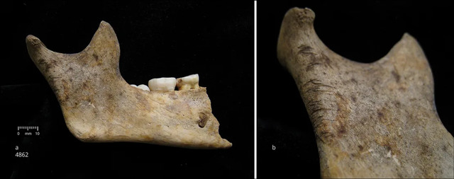 Linear marks on the jawbone of a 10-year-old child provide insights into handling practices after death.