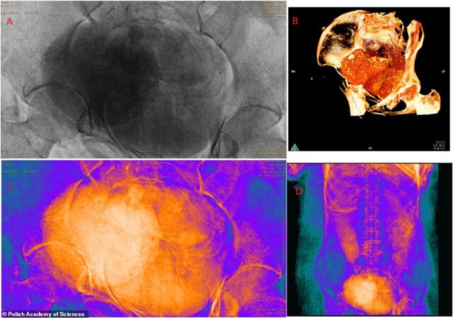 Scans reveal a faintly visible foetus in the mummy’s abdomen, a stunning discovery from the past.