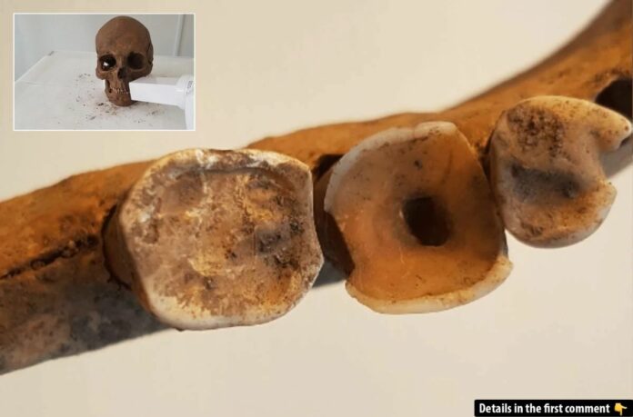 Uncovering Advanced Dentistry Practices Among Vikings: A Journey into Viking Oral Health