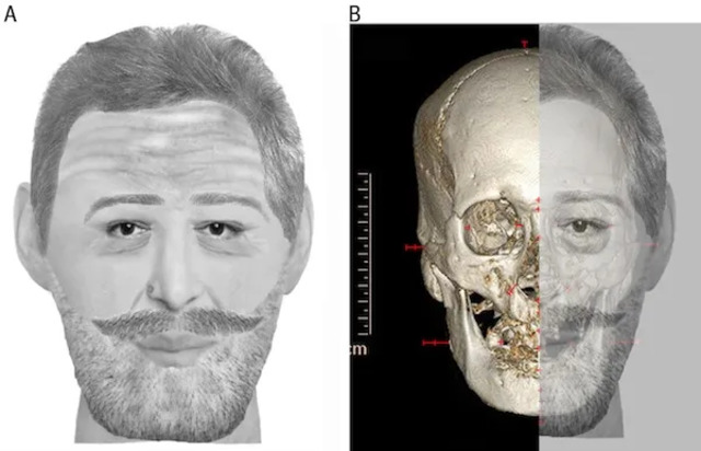 A 2010 facial reconstruction provided compelling evidence that the preserved head belonged to King Henry IV, though degraded DNA samples initially hindered conclusive analysis. (Image credit: Phillippe Carlier | British Medical Journal)