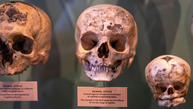 A museum exhibit displays three skulls marked with distinctive pock-marks on their frontal bones, labeled as evidence of tertiary syphilis.