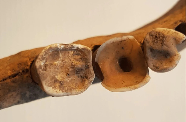 A precisely filed hole from the tooth’s crown to its pulp—an ancient technique to alleviate pain and combat infection.