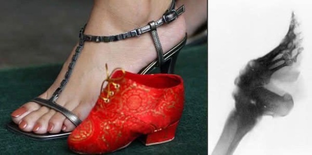 A comparison of a modern shoe, a lotus shoe, and an X-ray of a bound foot, highlighting the drastic physical alterations caused by foot-binding.