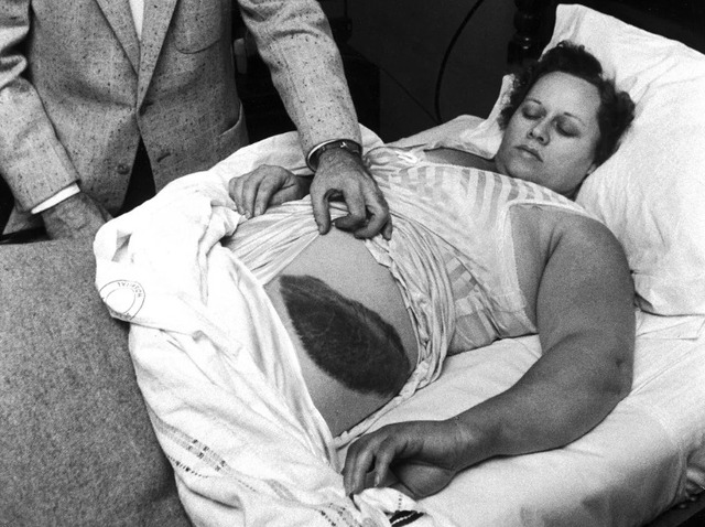 Ann Hodges with a large bruise on her hip, caused by a meteorite striking her—a truly cosmic encounter.