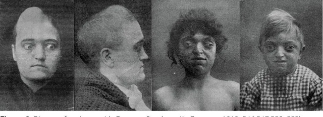 Historic photos of patients with Crouzon Syndrome provide a fascinating comparison for interpreting the figurine’s features. (Credit: Crouzon, 1912/Barroso, M. do S., Antropologia Portuguesa, 2024)