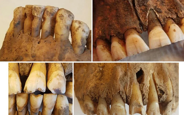 Key findings include: 1) Evidence of tooth picking in the lower incisors, 2) Filed front teeth, 3) Signs of habitual wear on central incisors, and 4) A modified central incisor showing fistulated apical infection.