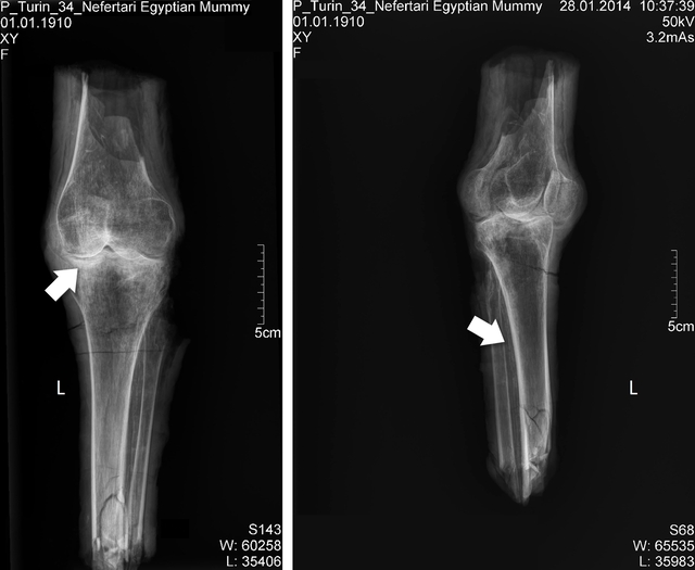 The embalming materials were found to align with the Ramesside mummification practices, while X-rays of the left knee showed signs of arteriosclerosis, hinting that the legs might belong to an elderly person.