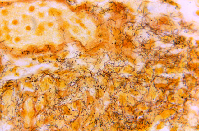 This 1966 microscope image from the Centers for Disease Control and Prevention shows a tissue sample teeming with corkscrew-shaped Treponema pallidum spirochetes, the bacteria responsible for syphilis.