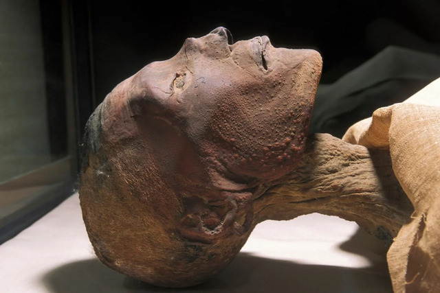 One telling example is Ramesses V of the 20th Dynasty, whose mummified remains display the distinctive scars of smallpox.